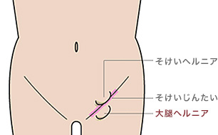 大腿(だいたい)ヘルニア
